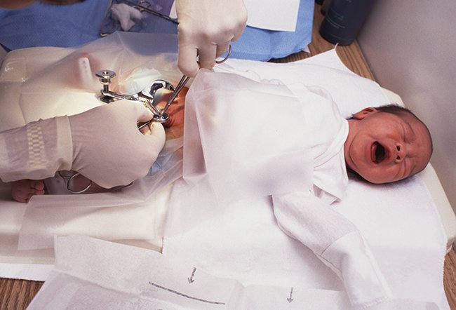 Circumcision is the removal of the skin covering the tip of the penis. There is no clear answer as to whether it is better to not be circumcised as circumcision has medical, ethical, and cultural concerns.