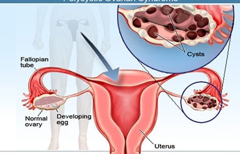 Different Types of Ovarian Cyst 