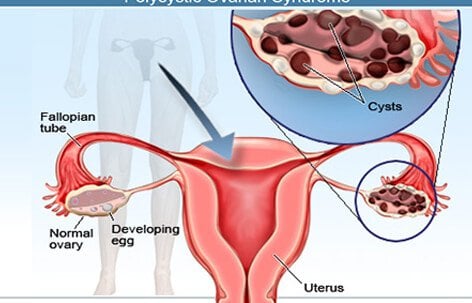 Ovarian Cysts