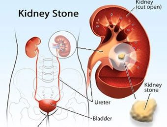 The First Signs of Kidney Stones (Nephrolithiasis)