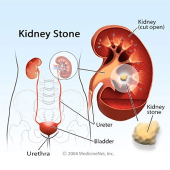 Illustration of kidneys and kidney stone.