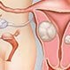 Uterine fibroids picture