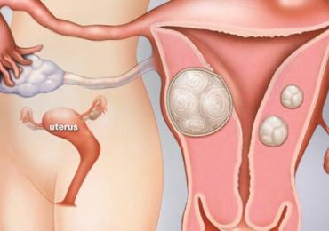 Uterine Fibroids (Benign Tumors of the Uterus)