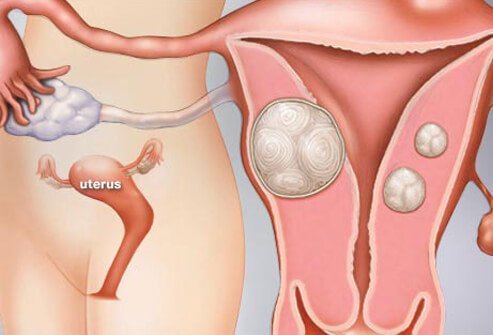 Uterine Fibroids (Benign Tumors of the Uterus)