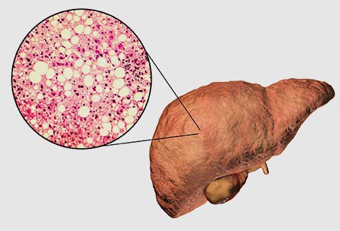 What Is Fatty Liver Disease
