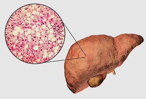 What Is Fatty Liver Disease?