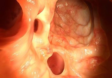 Can Diverticulitis Cause Urinary Symptoms?