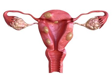 Is It True That Every Woman Has Fibroids?