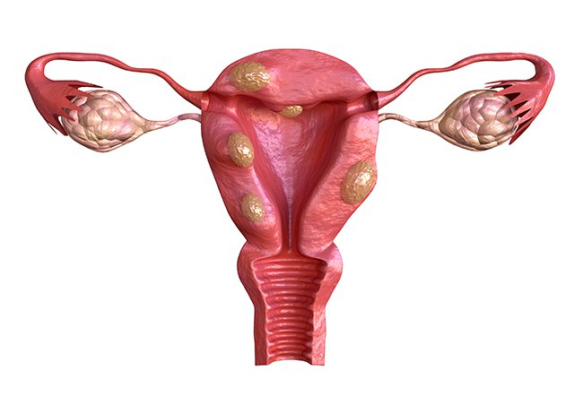 Is It True That Every Woman Has Fibroids