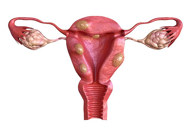 Is It True That Every Woman Has Fibroids?