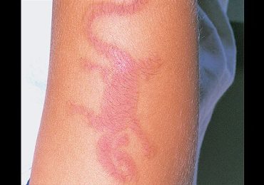 Picture of Allergic Contact Dermatitis (Arm)