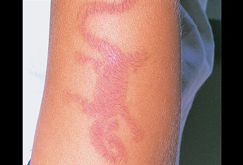 Picture of Allergic Contact Dermatitis (Arm)
