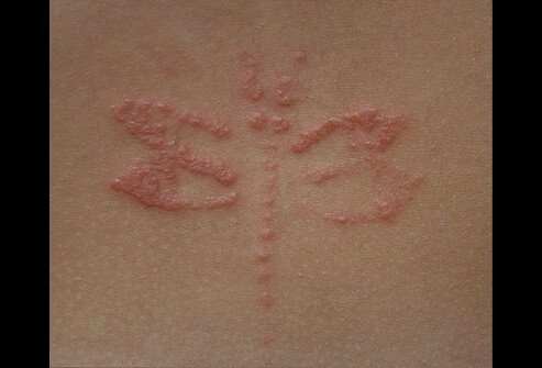 Picture of Allergic Contact Dermatitis (Tattoo)
