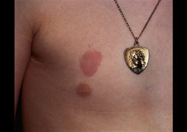 Picture of Nickel Contact Dermatitis from Necklace