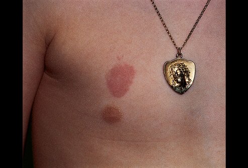 Picture of Nickel Contact Dermatitis from Necklace