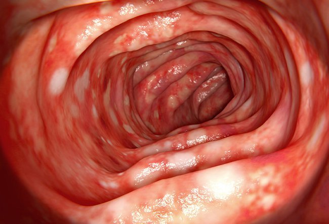 What Happens When You Have Ulcerative Colitis?